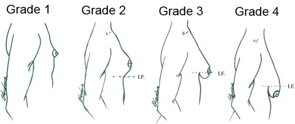 Gynaecomastia (Man Boob) grades